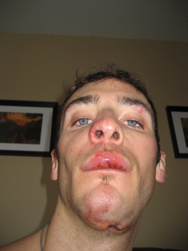 With a broken face after a gnarly ski crash. Circa 07'